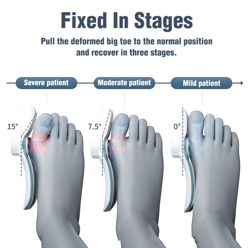 Relifix™ Bunion Corrector Pro